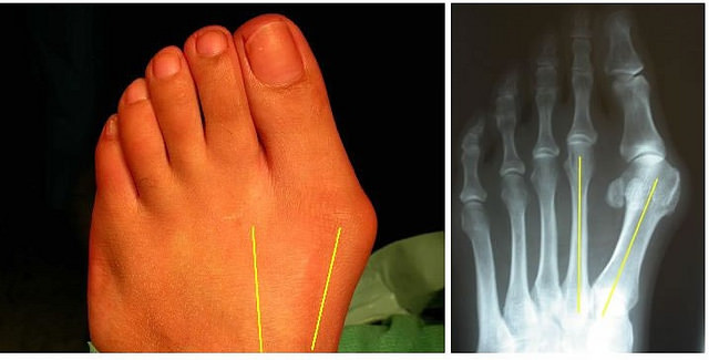 BUNIONS - hallux valgus